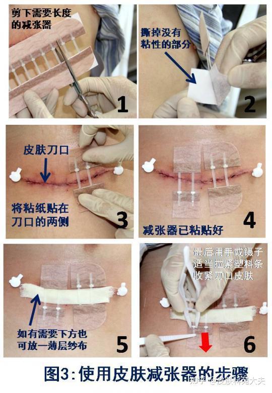 皮肤减张器使用指导及常见问题解答