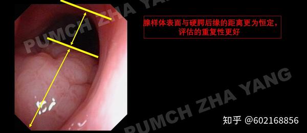 腺样体肥大程度的判断方法