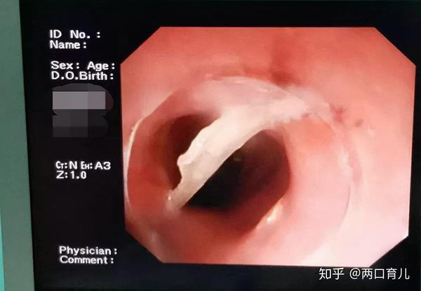 一般来说, 卡住鱼刺的位置有三个:左右扁桃体处,喉咙梨状窝处和食道.