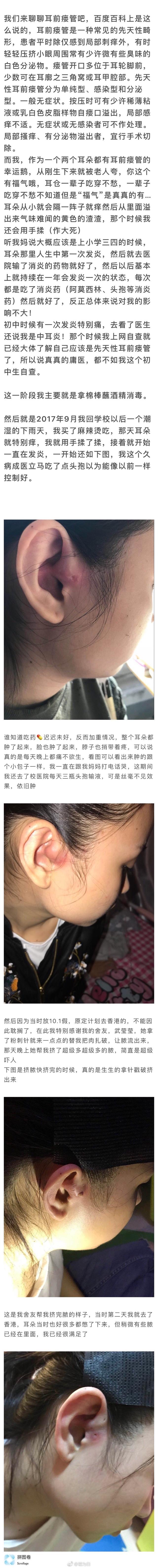 耳前瘘管手术治疗全过程