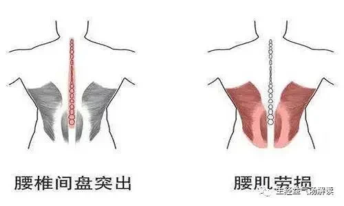 腰肌劳损:疼痛部位位于腰部的一侧髂嵴处,而不是中央.