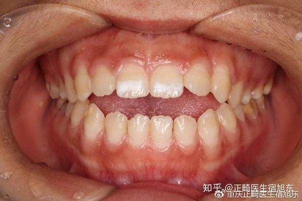 后天的环境因素导致的牙齿,颌骨,颅面的畸形 错合畸形的发病率(2000年