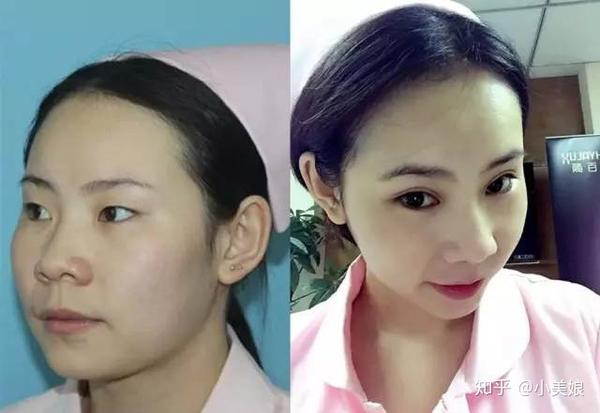 解决了肿眼泡,眼皮松弛,小眼睛,单眼皮的烦恼