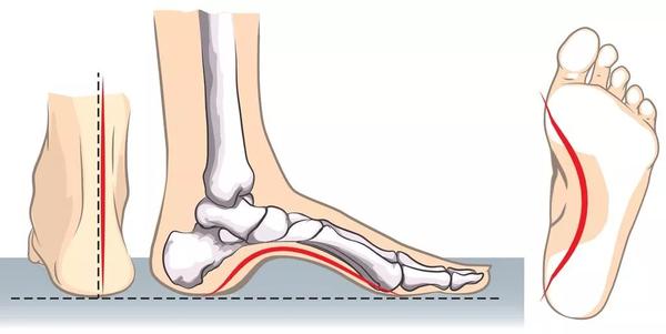 最容易被忽视的足弓问题却足以影响全身