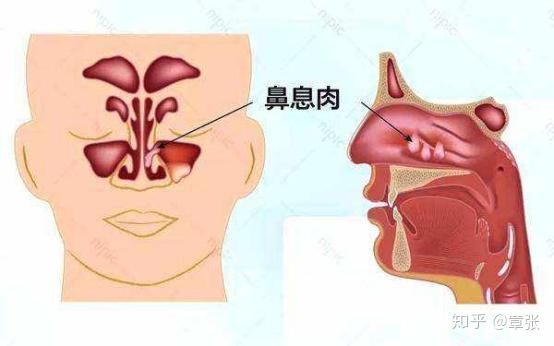 5, 多发性息肉癌变的几率增加(类似于1 1>2的原理)如一个息肉的癌变率