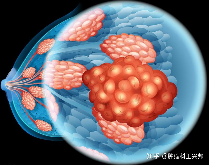 乳腺癌的早期病变都有哪些治疗方式如何选择
