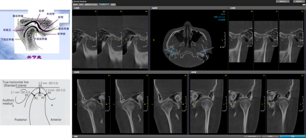 伯爵cbct临床应用:双侧颞颌关节