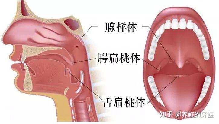 儿童时期免疫系统没发育完全,依靠的是咽淋巴环.