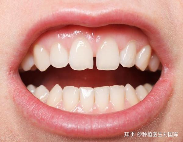 牙缝大?这几大原因需要注意!不同原因治疗方法也不同