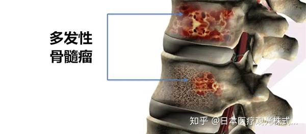 下背疼痛,长期贫血莫轻忽!不可不知的多发性骨髓瘤