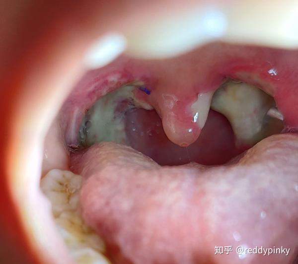 我的扁桃体终于摘除了,分享一下