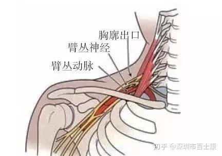 静脉的压迫而出现神经,血管压迫症状,如手臂内侧感觉异常,有麻木疼痛