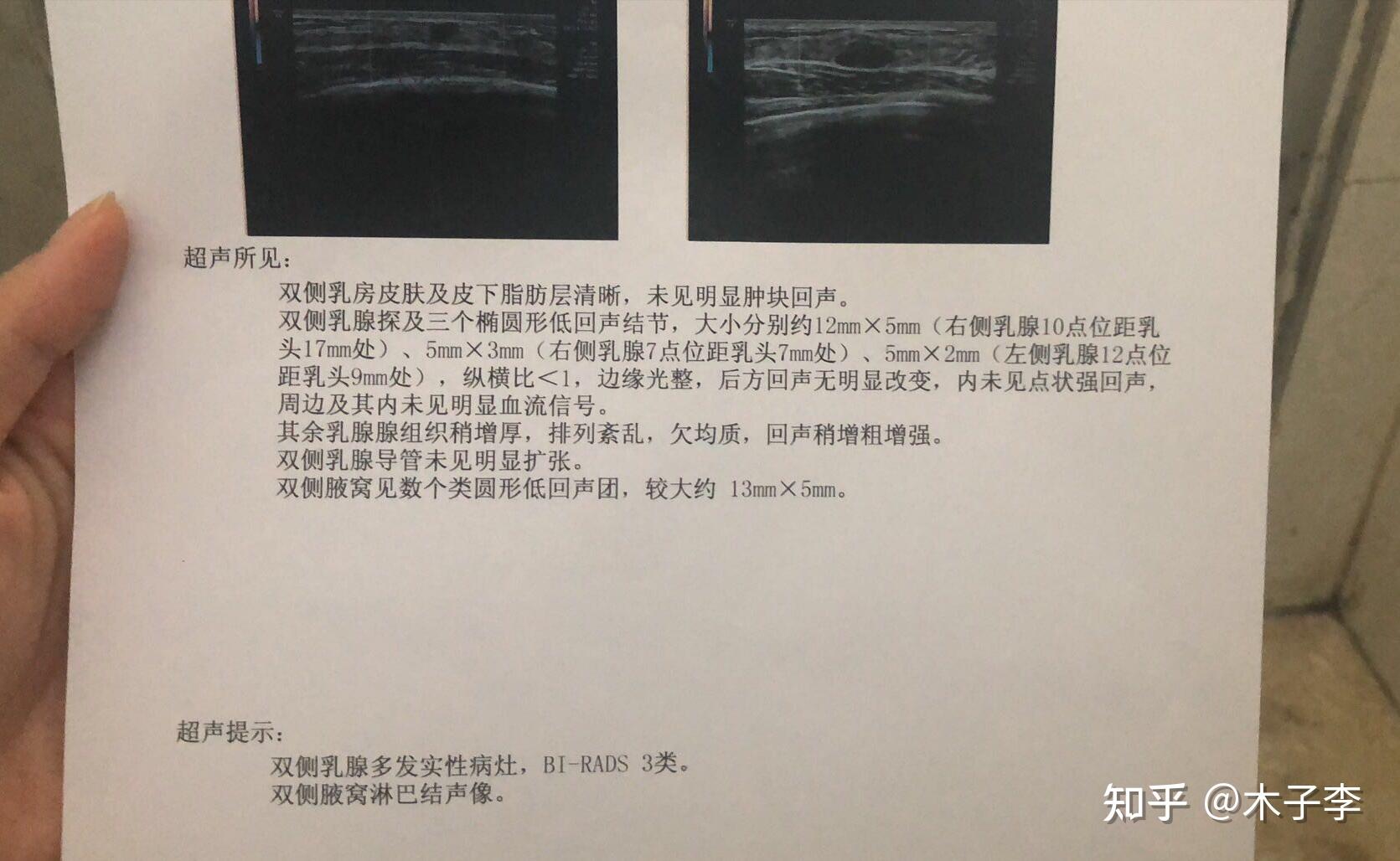 乳腺结节三类消除了终于不用在担心了