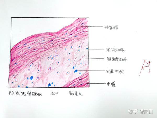 食管鳞状细胞癌 8.胃腺癌 9.脂肪肉瘤 10.动脉粥样硬化 11.