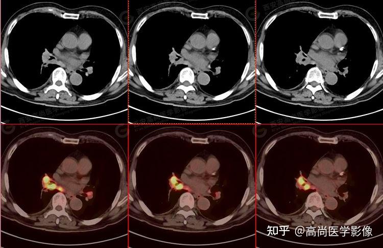5例肺鳞癌的病例 知乎