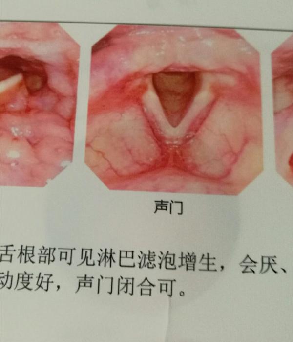 做完正颌手术三个月,长了声带息肉,牙齿条件不支持咬喉镜手术进行,有