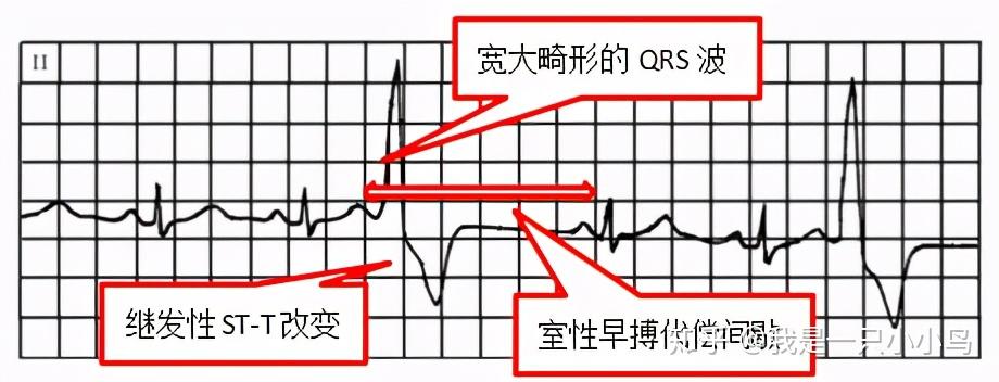 室性早搏也是很常见且较好辨认的心律失常,是心室内异位起搏点提早