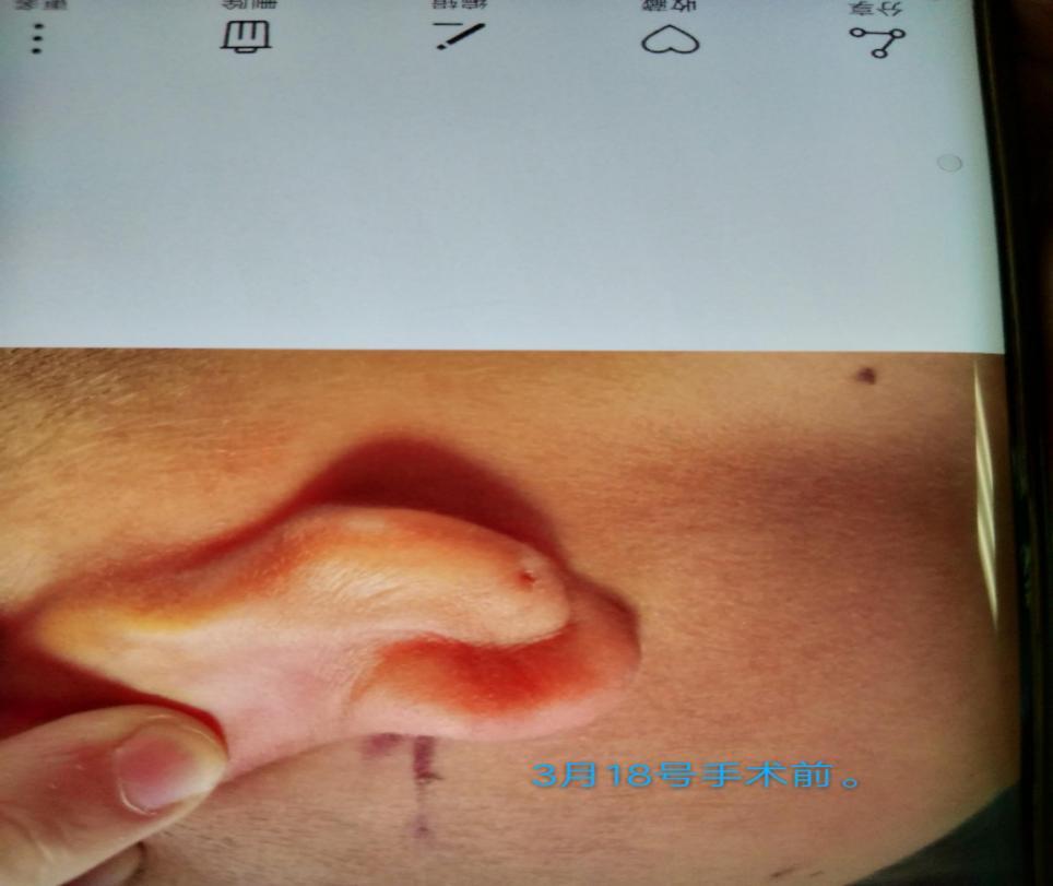深圳8岁儿童先天性耳前瘘管手术失败之始末手术4天后便复发甚至恶化是
