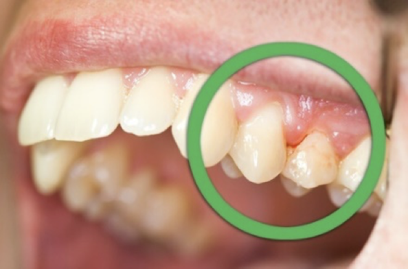 细菌,牙菌斑在牙缝里猖獗地生长,腐蚀牙齿,侵袭牙龈.