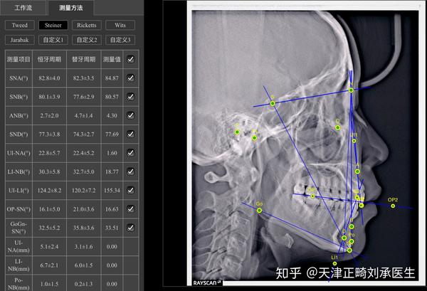 很久没给大家分析病例了,今天这是个比较难的牙齿情况,给大家分析