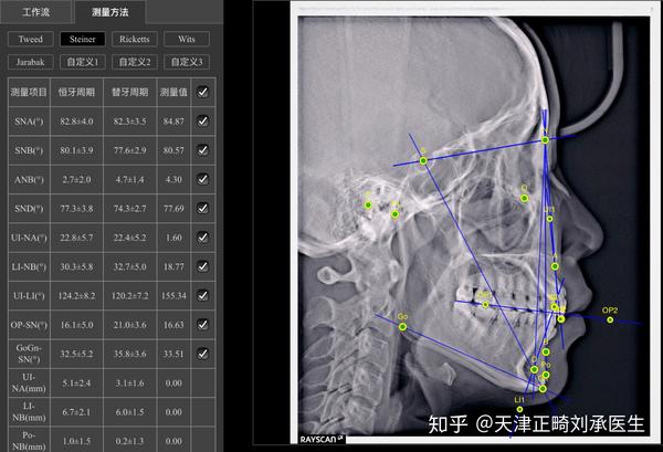 口内检查:磨牙中性关系,轻度拥挤,上颌前牙舌倾,深覆合.