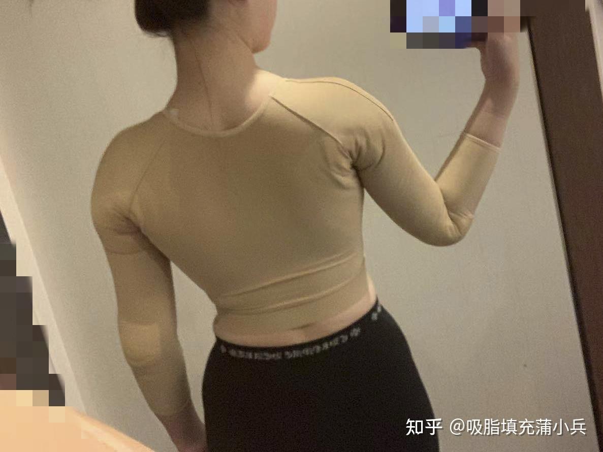 吸脂有哪些危害和后遗症