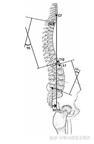 当前很多研究在关注矢状位脊柱曲线与骨盆之间的相关性,并已