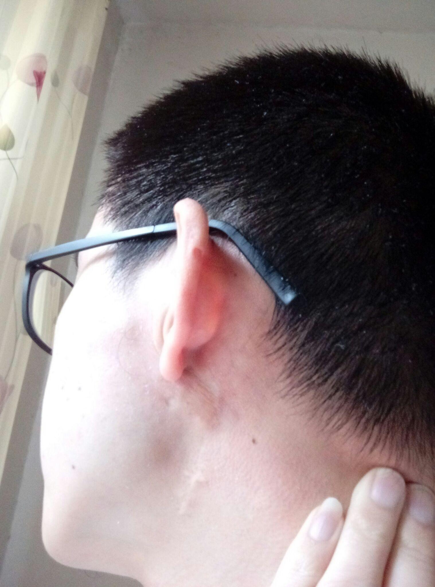 面颈部,手术疤痕,术后4.5年,有没有什么进一步淡化疤痕的方法?