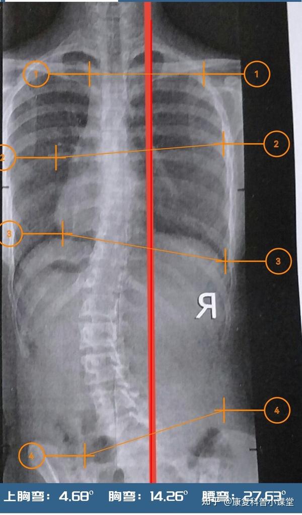 经测量发现,胸弯cobb角为14.26度,腰弯cobb角为27.63度均大于10度
