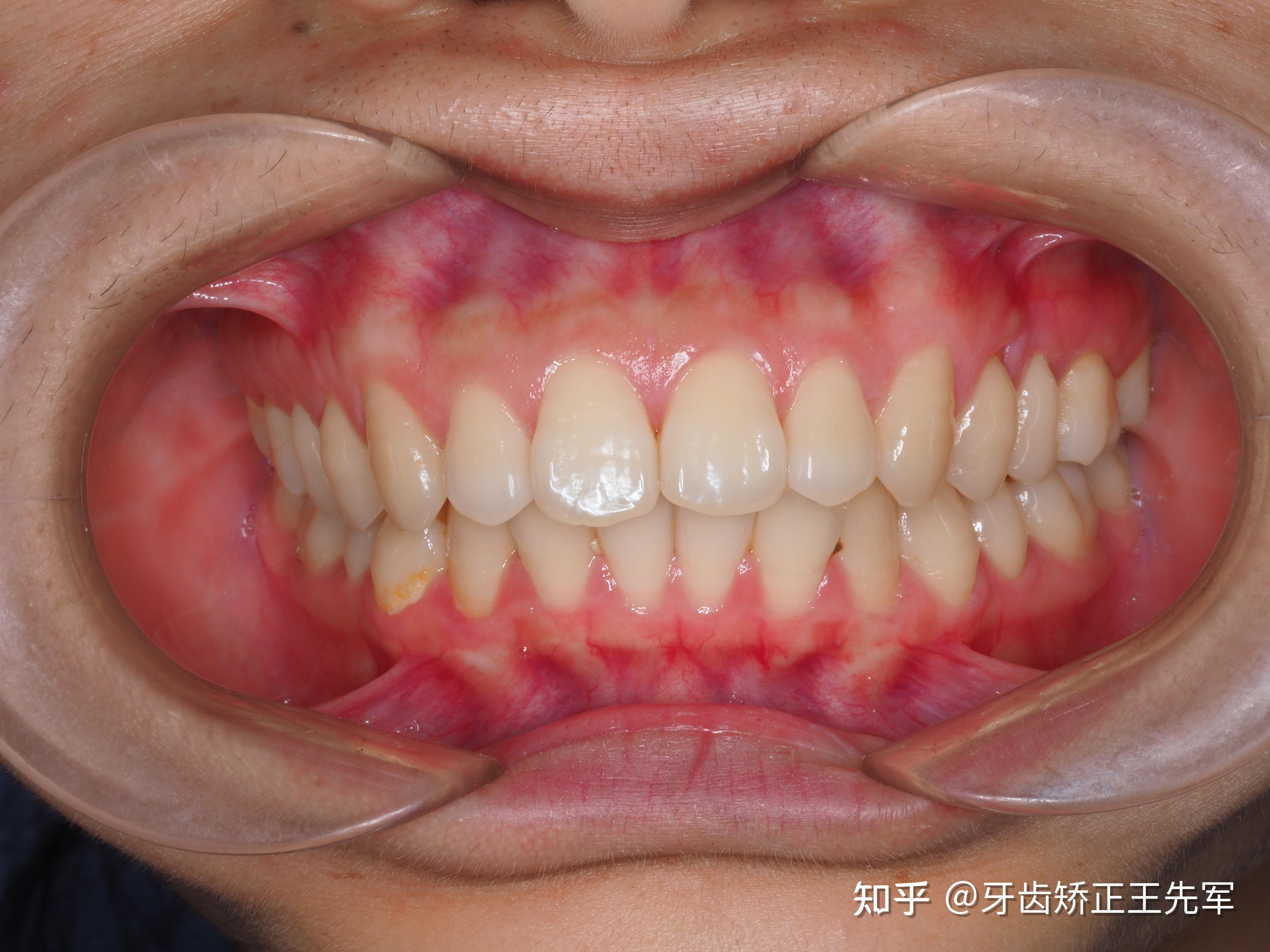 苏州牙齿矫正-牙齿畸形隐适美矫正案例