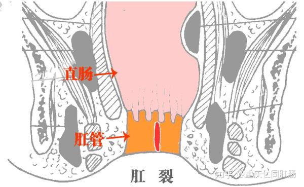 肛裂流血了怎么办重庆医院仁同肛肠