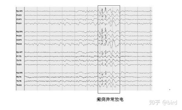 图8—2 癫痫异常放电的脑电图