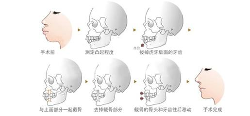 接受不了正颌!