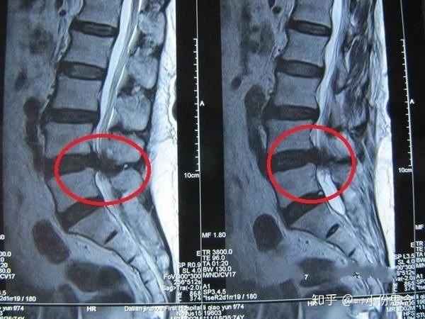 骨神经痛跟腰椎间盘突出症是一回事吗?图片
