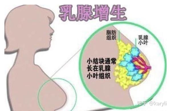 乳腺结节三级投保 乳腺结节可以买重疾险吗