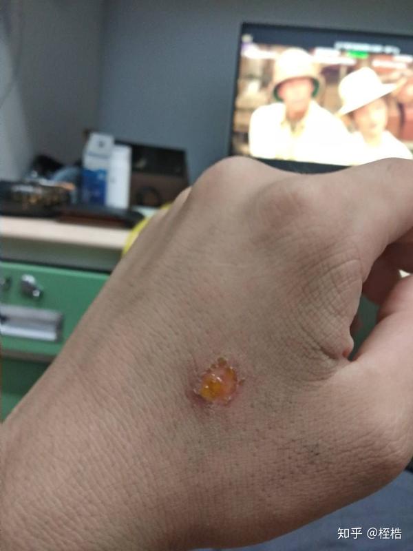烟头烫在身上是怎样的?