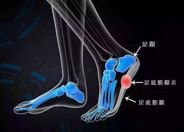 足跟痛:康复师教你这几招,可以缓解90%的足跟痛