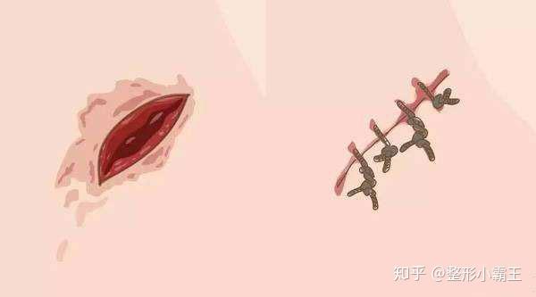 3,拆线