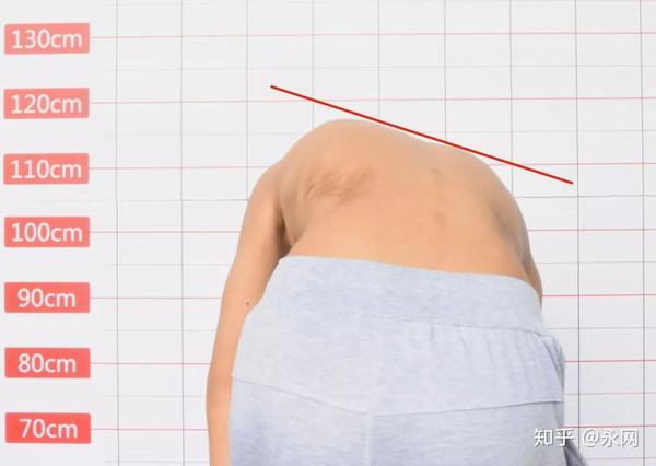 3,剃刀背:表现为弯腰时,从后方看去,两侧背部高低不平整