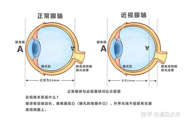 正常眼轴与近视眼轴对比