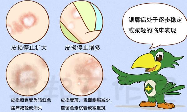 来~皮肤科专家来教你如何判断银屑病病情变化