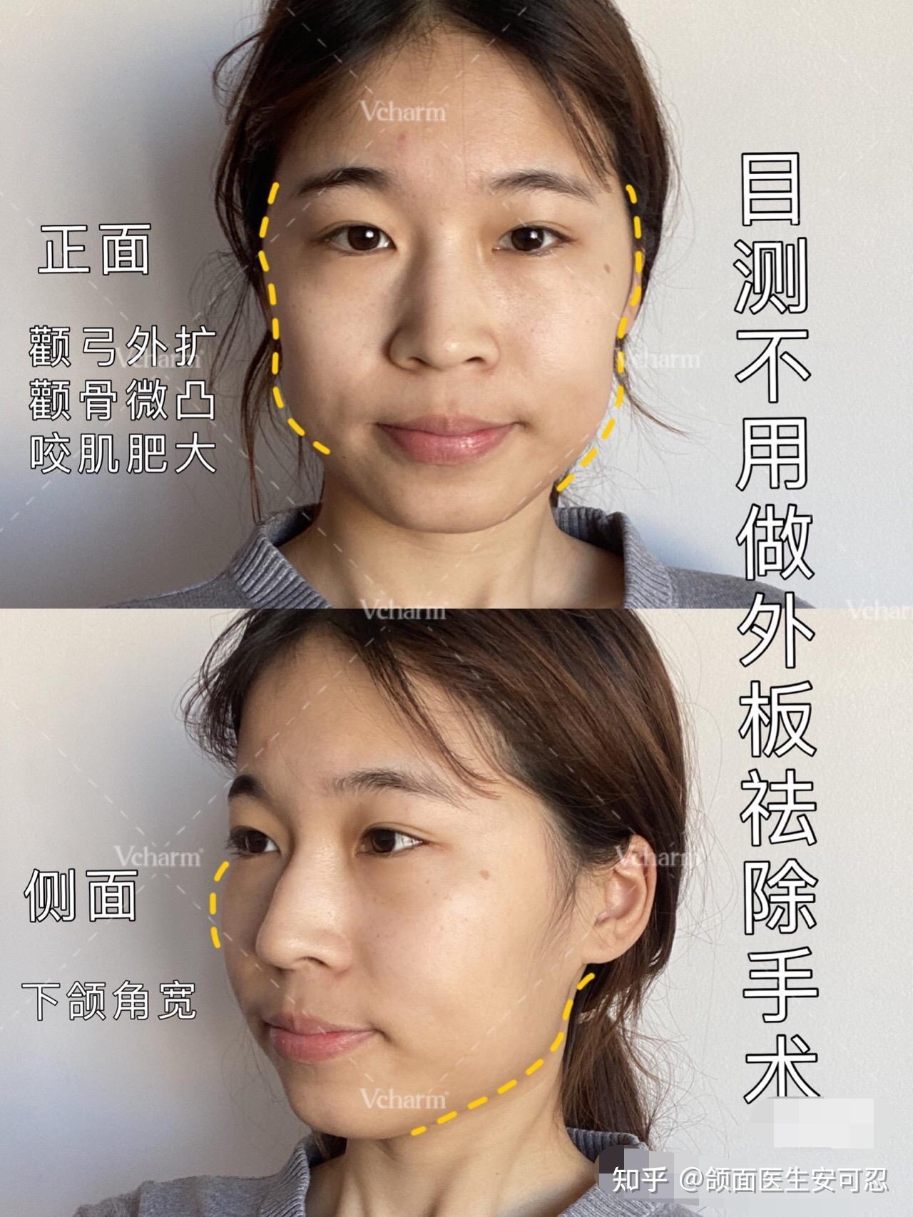 不劈外板下颌角手术就失败了吗