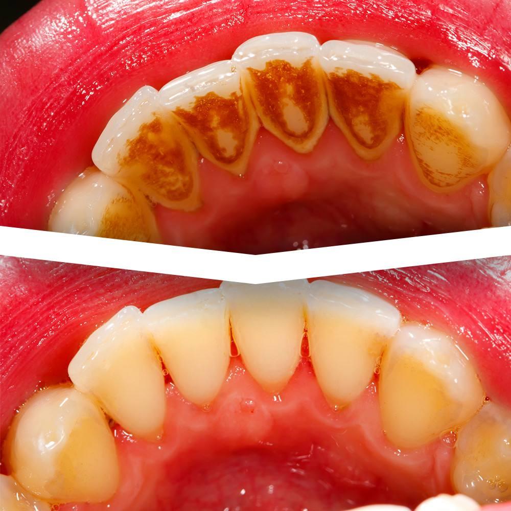 刷牙出血,异味口气,牙结石堆积…你的牙周真的没有病吗?