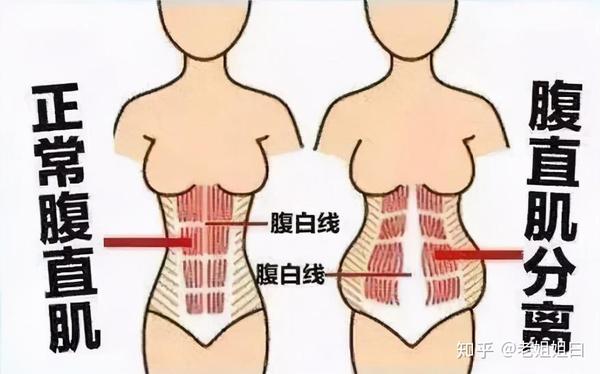 扩张延伸,两侧的腹直肌会从腹中线——也就是腹白线的位置向两侧分离