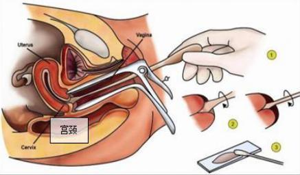 05/1000 人,而和筛查间隔为2 年相比较预测的宫颈癌死亡率一致,但阴道