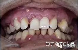 如果是,就要引起注意,牙缝越来越大可能是牙龈萎缩造成的