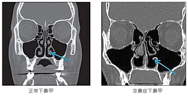 箭头所指即为缺失的下鼻甲 图源:iskin.com