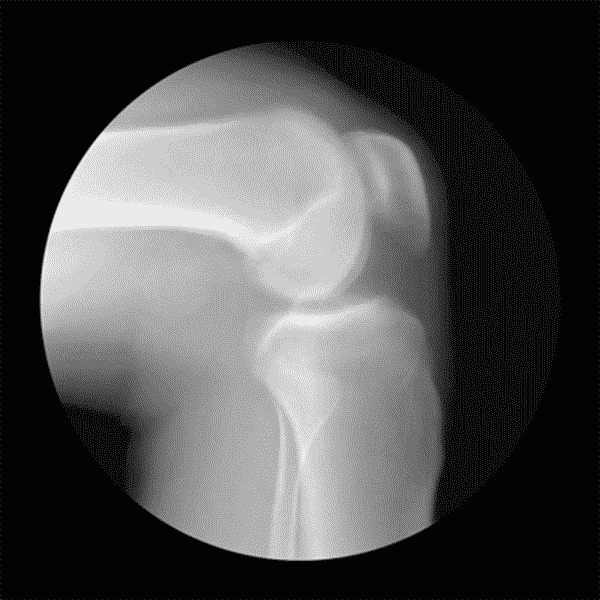 伸膝髌骨活动动图