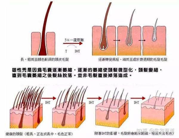 脂溢性脱发如何判断,怎么治疗?