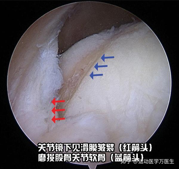 膝关节里那磨人的小妖精:滑膜皱襞(plica)综合症